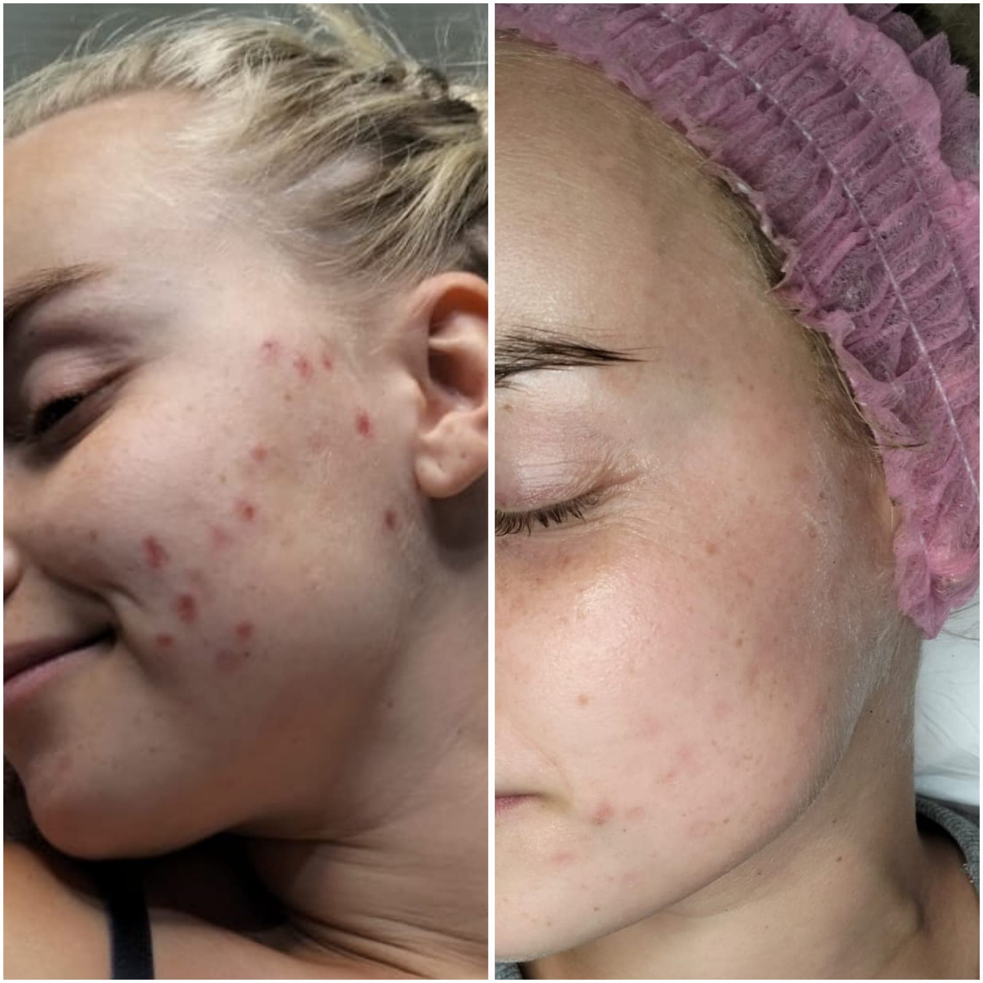 Real client before and after result at Hope Aesthetics