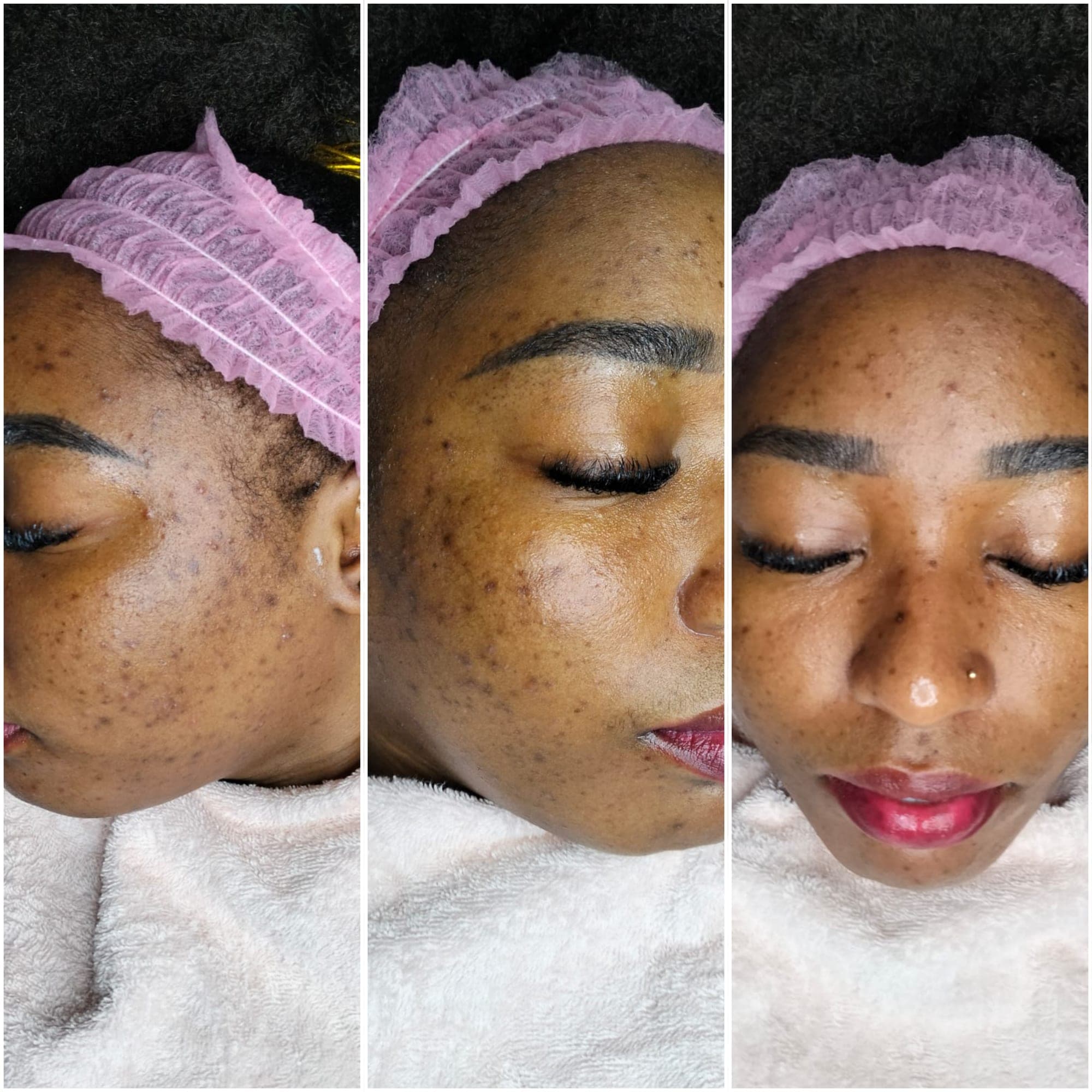 Real client before and after result at Hope Aesthetics