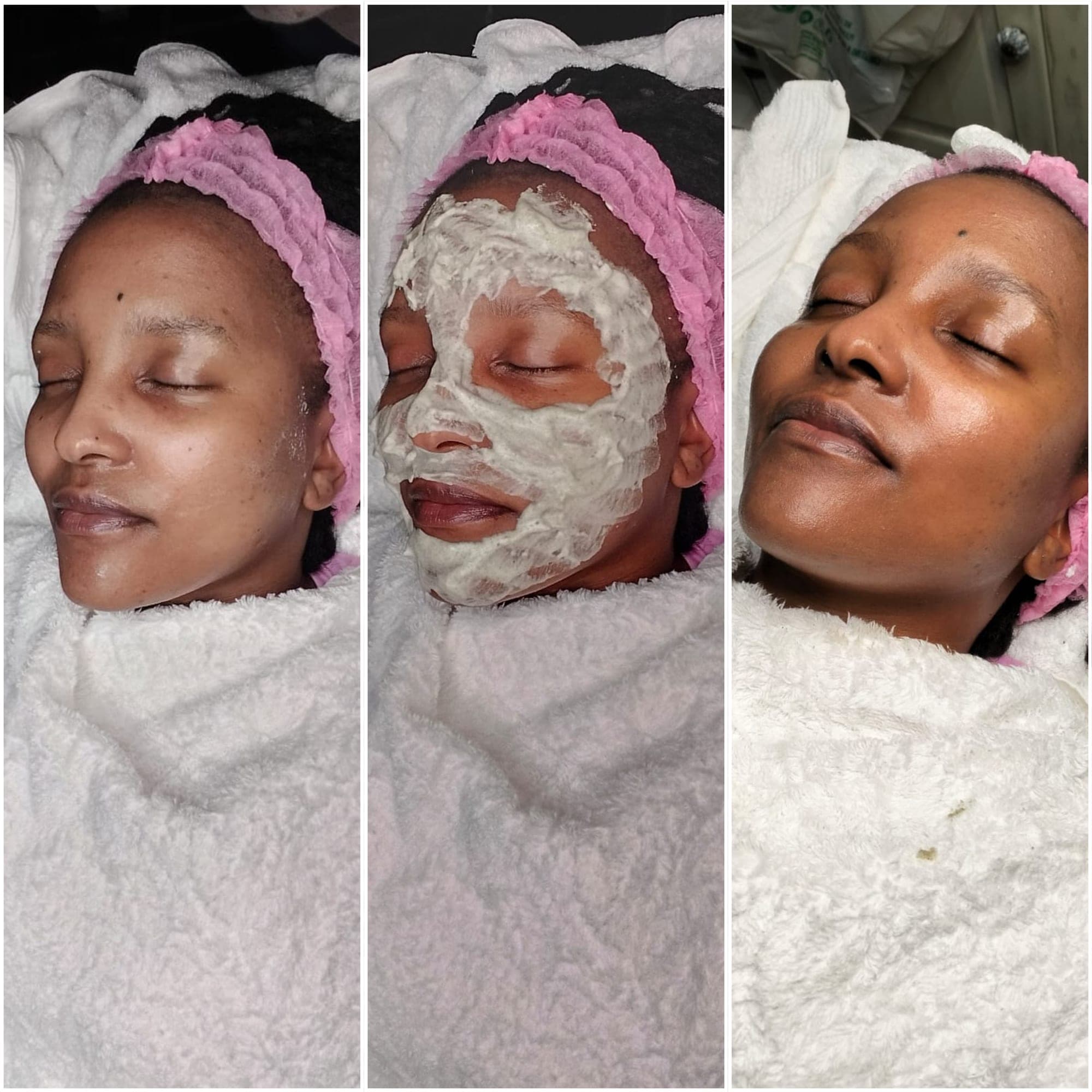 Real client before and after result at Hope Aesthetics