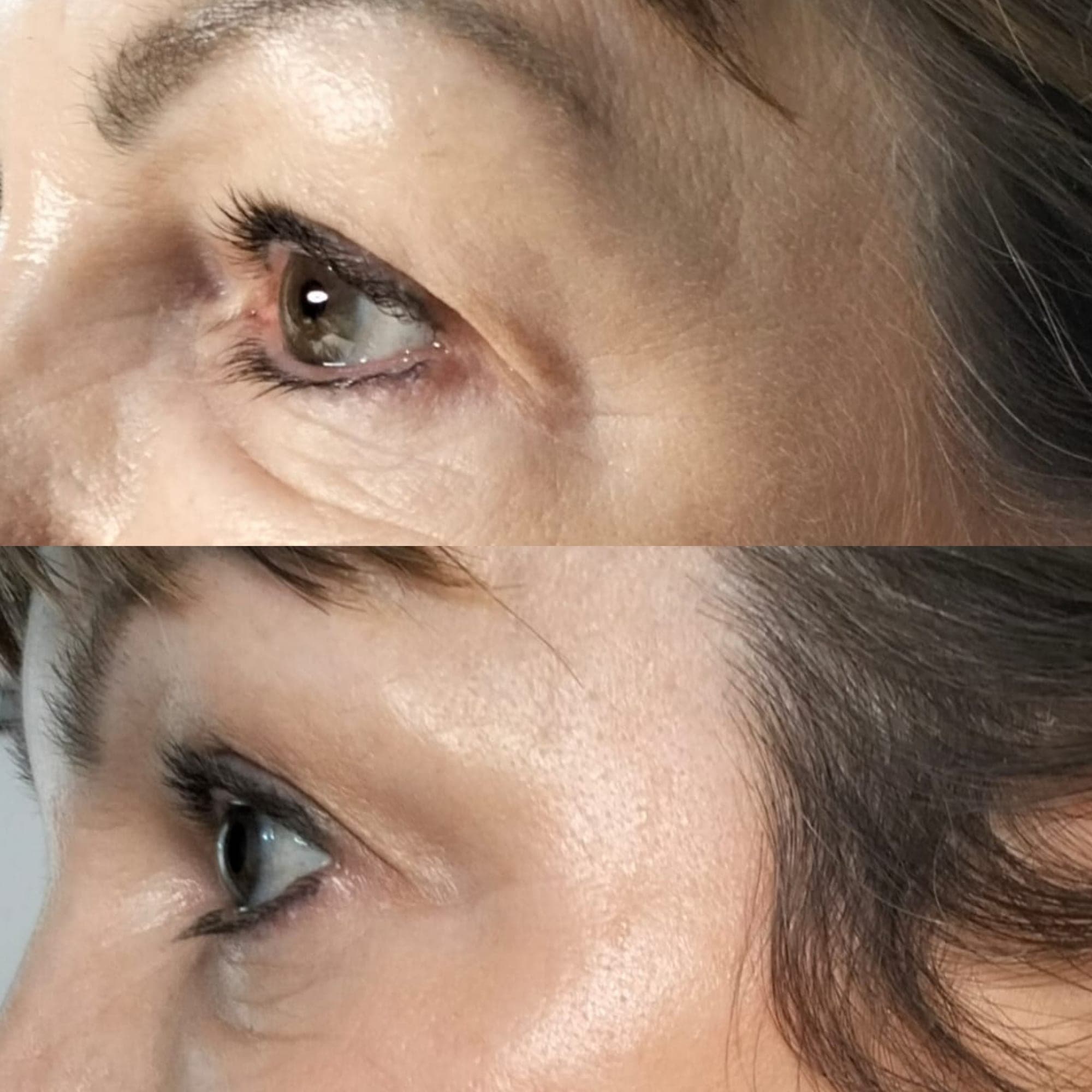 Real client before and after result at Hope Aesthetics