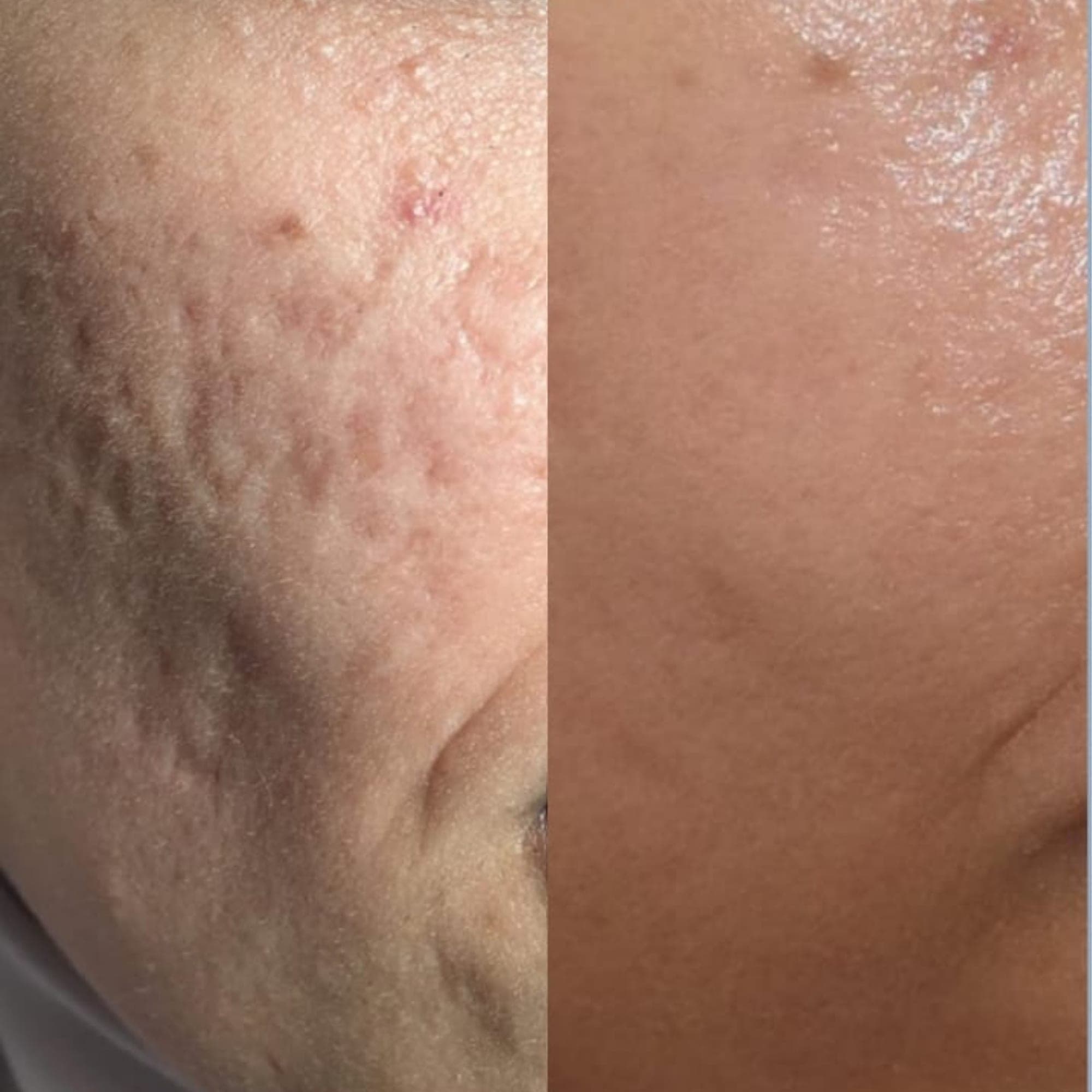 Real client before and after result at Hope Aesthetics